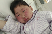 孩子一觉醒来脸肿成发面馒头，家长如何应对儿童突发水肿？