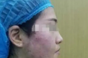 女子线雕手术三年后脸上钻出一根线，医疗美容风险需警惕！