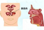 苟伟死因揭秘，鼻息肉肥大引发呼吸骤停，令人惋惜