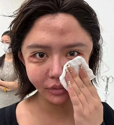 韩安冉抽脂术后留下七八个疤痕，揭秘网红整形背后的风险与代价