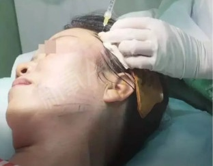 女子线雕手术三年后脸上钻出一根线，医疗美容风险需警惕！