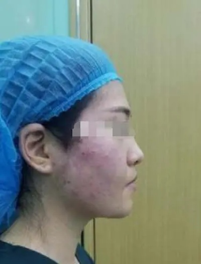 女子线雕手术三年后脸上钻出一根线，医疗美容风险需警惕！