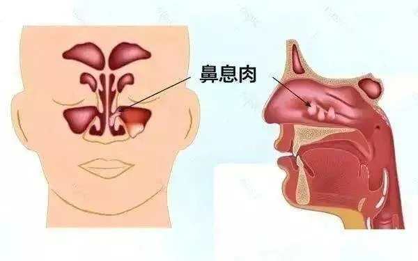 苟伟死因揭秘，鼻息肉肥大引发呼吸骤停，令人惋惜