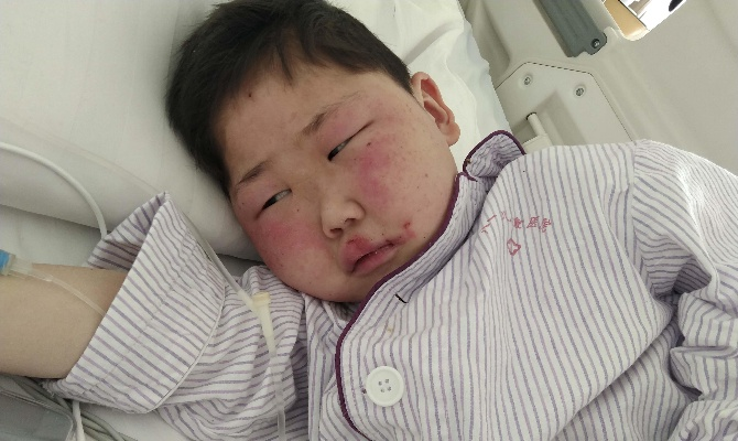 孩子一觉醒来脸肿成发面馒头，家长如何应对儿童突发水肿？
