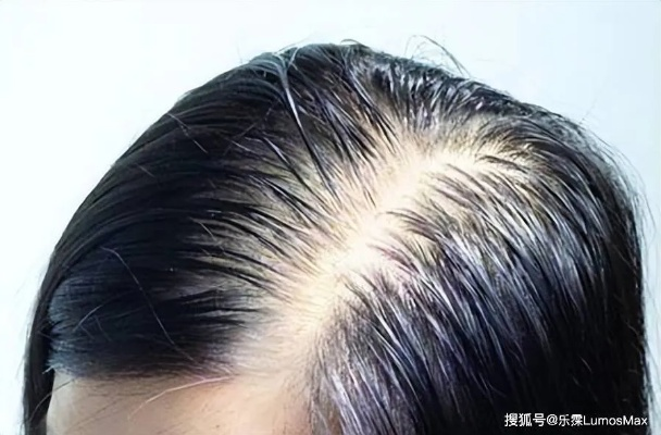 女子因脱发30岁被误认为奶奶，脱发困扰，年轻女性的隐形痛